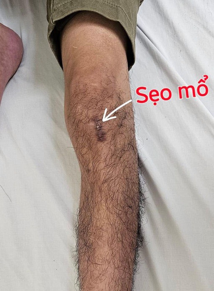 Phương pháp phẫu thuật giúp người bệnh bị gãy xương có thể tập đi ngay sau mổ- Ảnh 1. Phương pháp phẫu thuật giúp người bệnh bị gãy xương có thể tập đi ngay sau mổ- Ảnh 1.