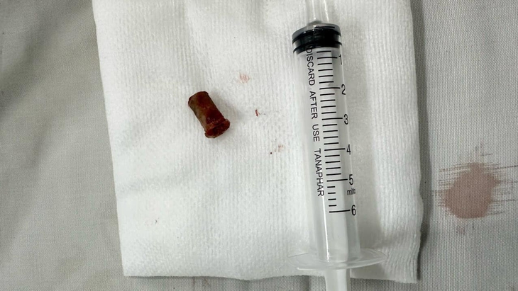 Hy hữu chiếc kèn nằm trong phổi bé trai gần 8 năm- Ảnh 2.