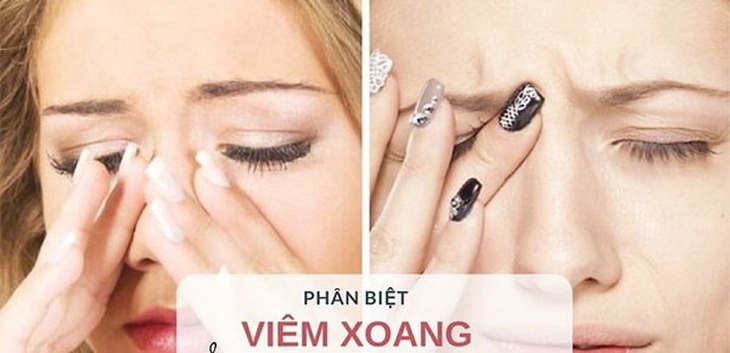 Viêm xoang và viêm mũi dị ứng là hai chứng bệnh thường gặp và gây nhiều phiền toái trong đời sống hiện nay. Ảnh minh họa