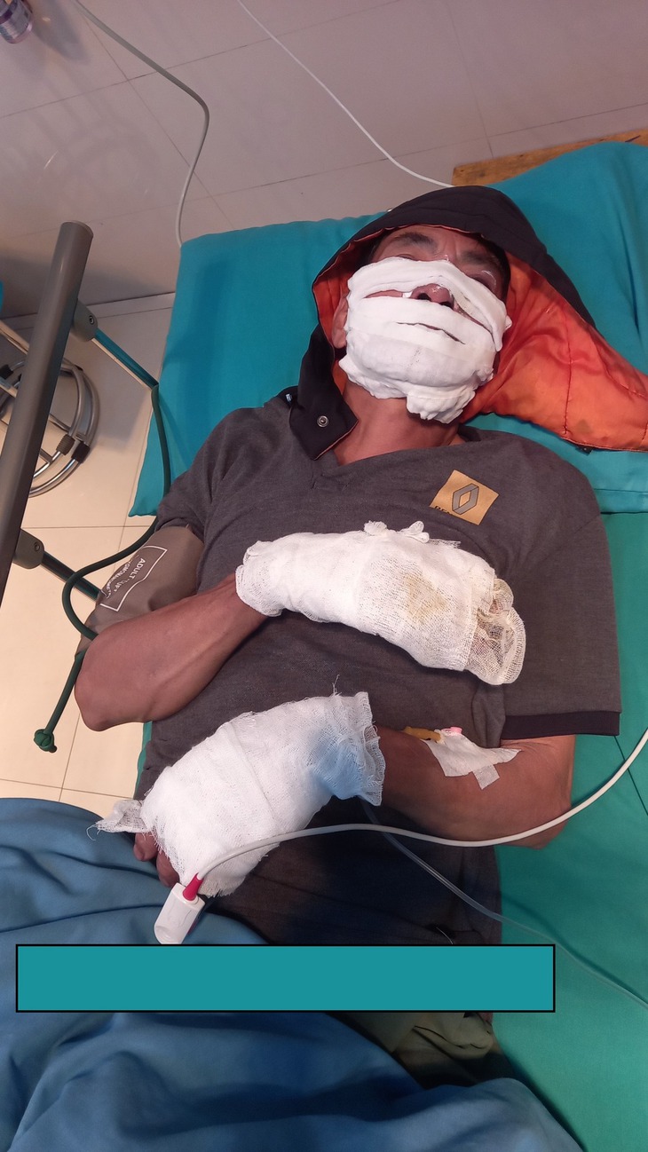 Bị bỏng nặng do thói quen sạc điện thoại qua đêm- Ảnh 2.