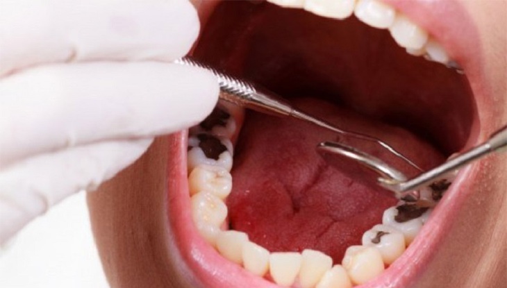 Răng bị ê buốt phải làm sao?- Ảnh 1.