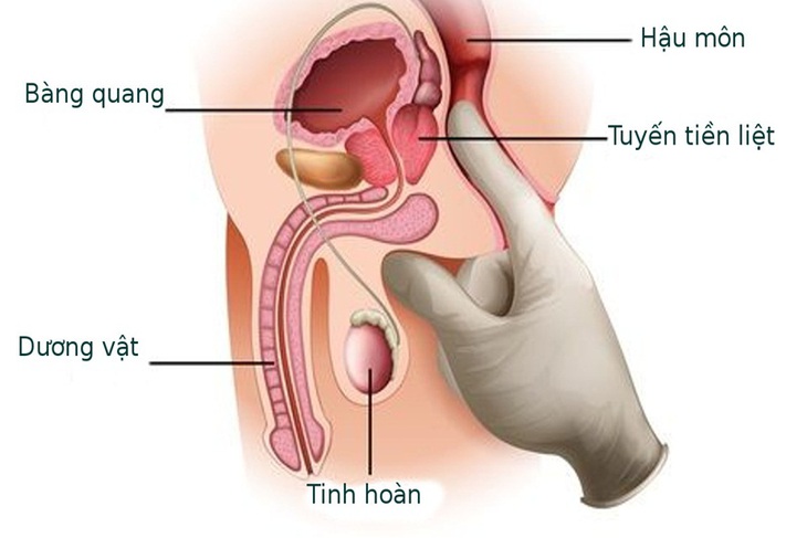 Bệnh ở tuyến tiền liệt có ảnh hưởng đến khả năng tình dục?- Ảnh 1. Bệnh ở tuyến tiền liệt có ảnh hưởng đến khả năng tình dục?- Ảnh 1.