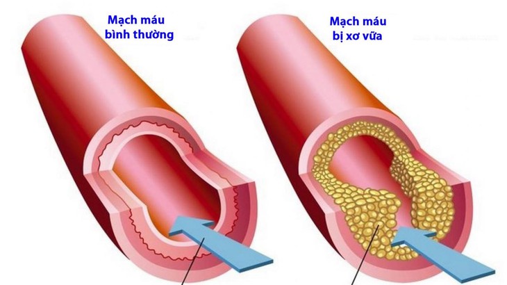 Bệnh lý tim mạch, mỡ máu, xơ vữa mạch máu, suy giảm đề kháng - Nguyên nhân và cách phòng ngừa- Ảnh 1. Bệnh lý tim mạch, mỡ máu, xơ vữa mạch máu, suy giảm đề kháng - Nguyên nhân và cách phòng ngừa- Ảnh 1.