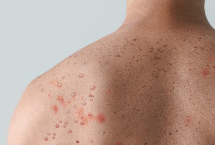 Nhận biết bệnh đậu mùa khỉ bằng cách nào- Ảnh 2.