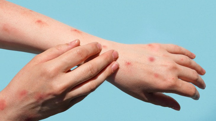 Nhận biết bệnh đậu mùa khỉ bằng cách nào- Ảnh 1.