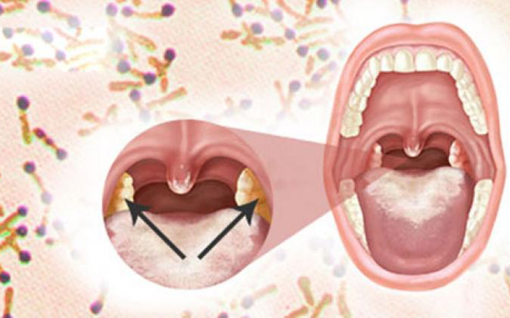 Tầm quan trọng của tiêm vaccine bạch hầu