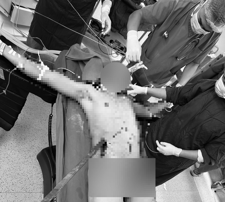 Nam thanh niên ngã giàn giáo bị thanh sắt dài 1,7m đâm xuyên từ hạ sườn phải lên ngực trái- Ảnh 2.