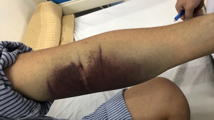 Lưu ý điều trị cho người mắc sốt xuất huyết trên nền đái tháo đường- Ảnh 1.