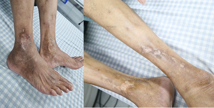 Suy giãn tĩnh mạch chân có thể phải ngồi xe lăn nếu điều trị không đúng cách- Ảnh 1.