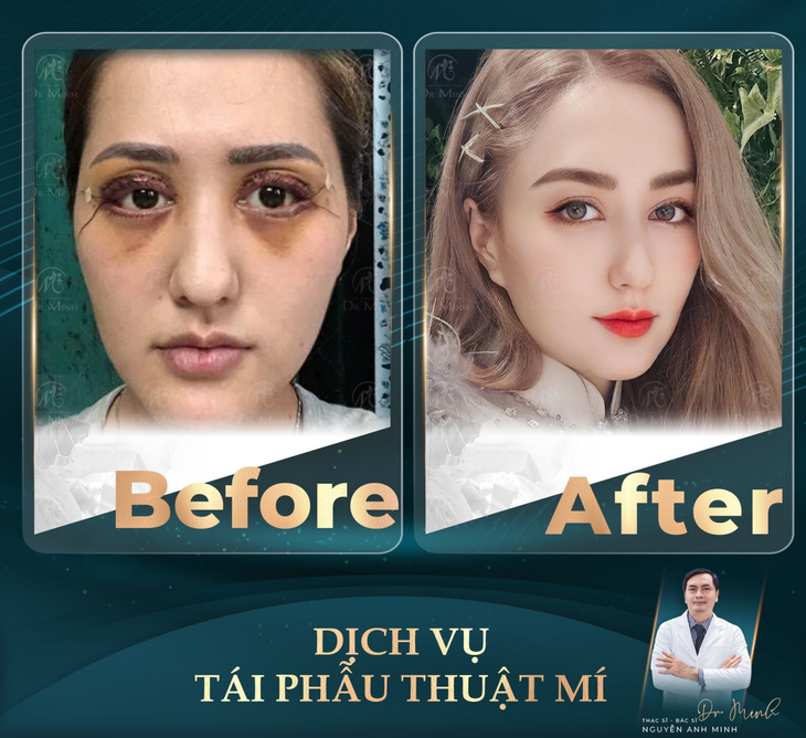 Bác sĩ phẫu thuật mí được nhiều chị em tin tưởng lựa chọn- Ảnh 2.