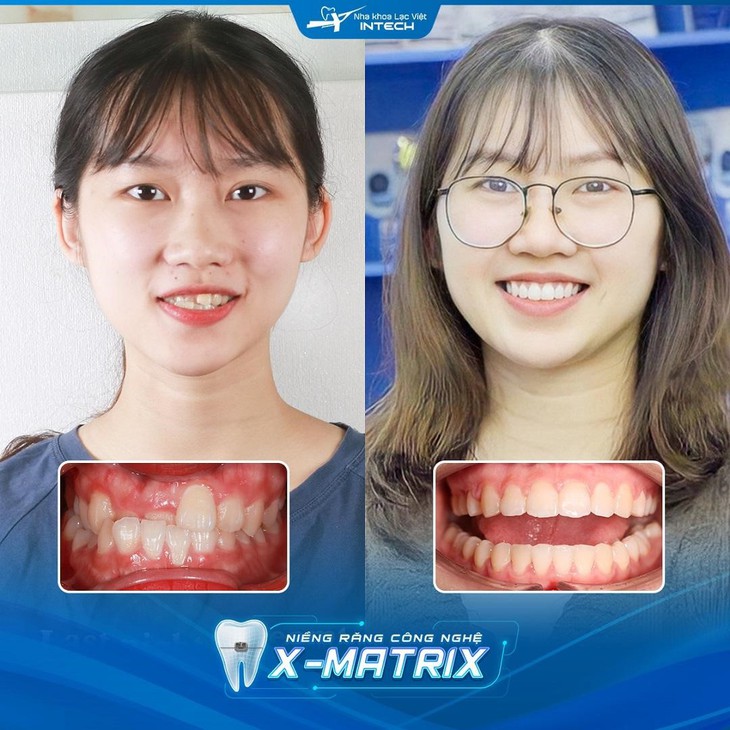 Trí tuệ nhân tạo: Sức mạnh đằng sau việc biết trước kết quả niềng răng!- Ảnh 1.