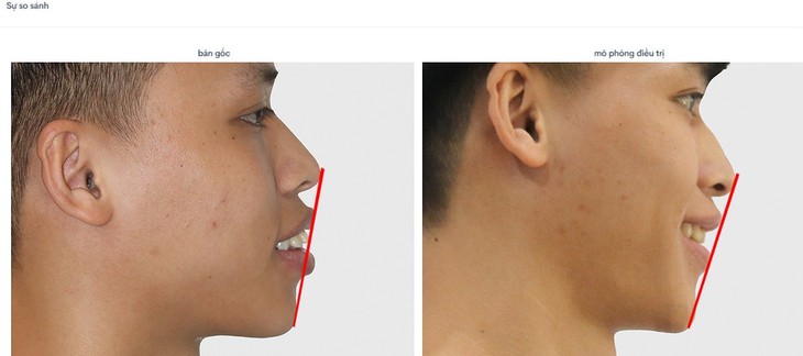 Trí tuệ nhân tạo: Sức mạnh đằng sau việc biết trước kết quả niềng răng!- Ảnh 3.