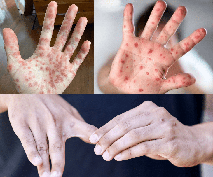 Bệnh đậu mùa khỉ và những nguy cơ cao với người có HIV- Ảnh 2. Bệnh đậu mùa khỉ và những nguy cơ cao với người có HIV- Ảnh 2.