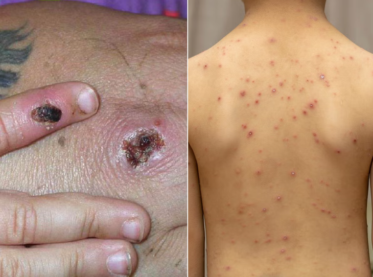 Nhận biết bệnh đậu mùa khỉ và thủy đậu - Ảnh 1.