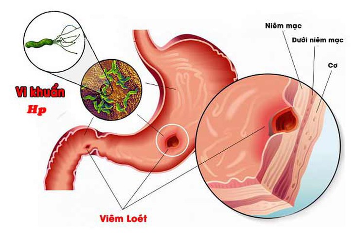 Cách dùng thuốc trị vi khuẩn H.Pylori hiệu quả để dự phòng viêm loét dạ dày- Ảnh 1.