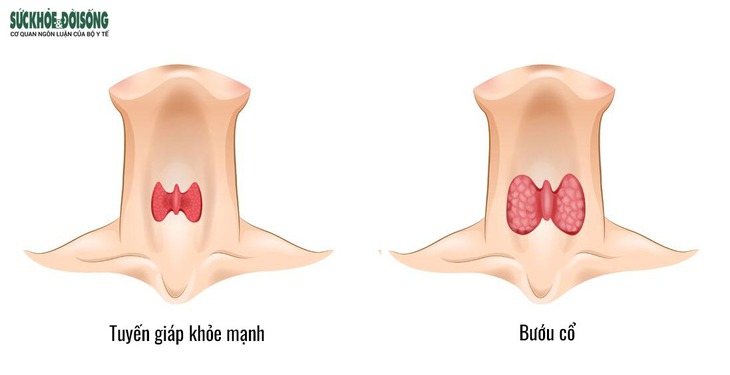 Bướu cổ: Triệu chứng, chẩn đoán và cách điều trị - Ảnh 2.