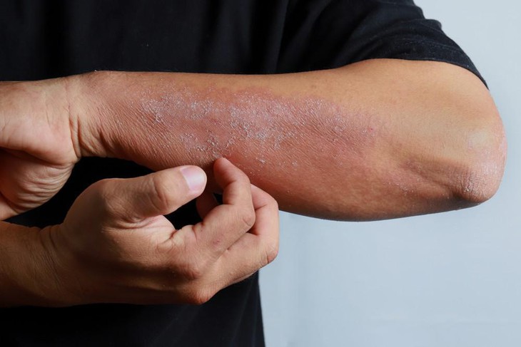 Viêm da tiếp xúc: Căn nguyên và thuốc điều trị - Ảnh 1. Viêm da tiếp xúc: Căn nguyên và thuốc điều trị - Ảnh 1.