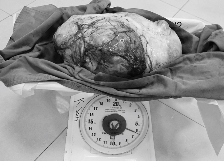 Giải thoát cho cô gái 28 tuổi khỏi khối u buồng trứng khổng lồ, nặng 6,5kg - Ảnh 1. Giải thoát cho cô gái 28 tuổi khỏi khối u buồng trứng khổng lồ, nặng 6,5kg - Ảnh 1.