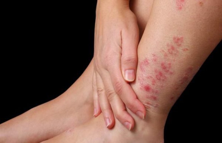 Viêm da cơ địa - Cách nào để có làn da khỏe đẹp?  - Ảnh 1.