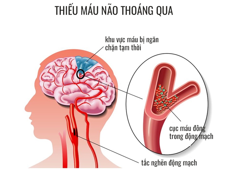 Bác sĩ cảnh báo cần lưu ý nếu bạn bị thiếu máu não thoáng qua - Ảnh 3.