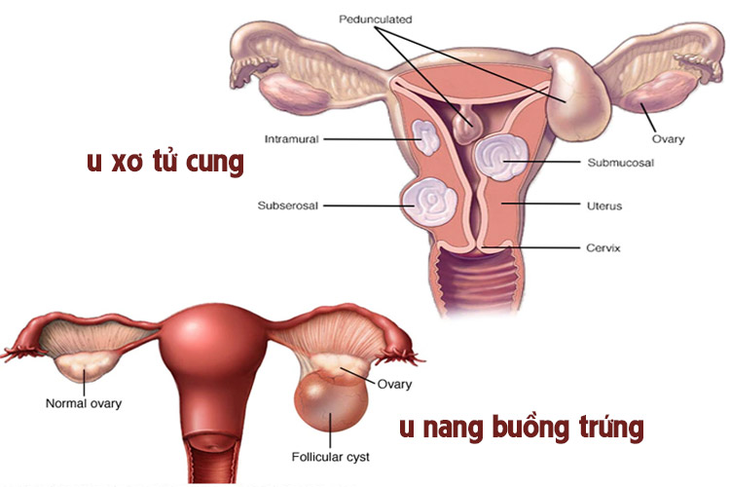 U xơ tử cung, u nang buồng trứng có nguy hiểm? - Ảnh 1.