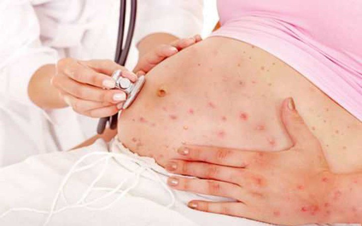 Virus Marburg cực nguy hiểm với phụ nữ mang thai, một số lưu ý để kiểm soát bệnh