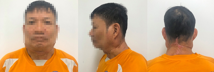 Tiêu thụ rượu nhiều, dễ có nguy cơ mắc bệnh hiếm gặp Madelung - Ảnh 3.