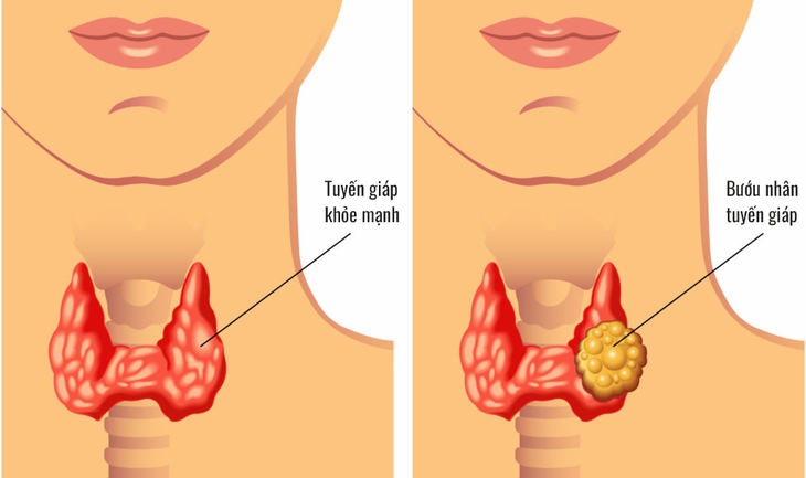 Bướu nhân tuyến giáp là gì? Biểu hiện mắc bướu nhân tuyến giáp - Ảnh 2.