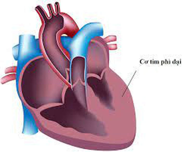 Hồi hộp, đau ngực, chóng mặt, hoa mắt…cảnh giác với bệnh cơ tim phì đại - Ảnh 1.