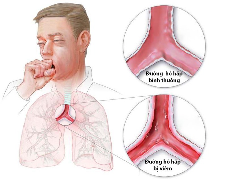 Phòng ngừa bệnh viêm đường hô hấp dưới như thế nào? - Ảnh 2.
