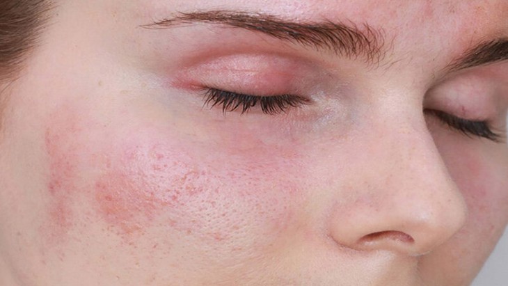 Tránh nám da khi dùng retinol chống lão hóa - Ảnh 1.