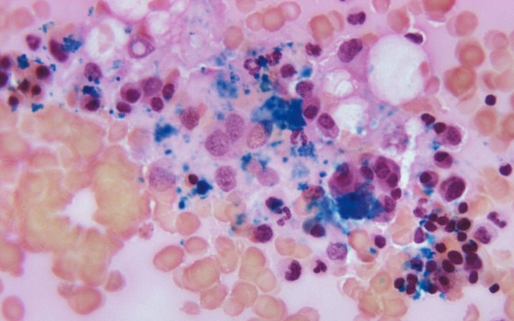 Điều ít biết về người đàn ông khỏi HIV sau khi ghép tế bào gốc chữa ung thư máu