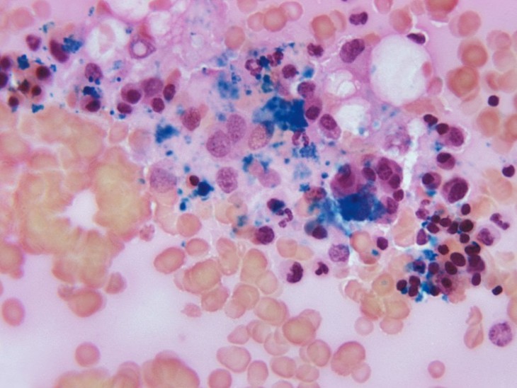 Khỏi bệnh HIV sau khi ghép tế bào gốc trị ung thư máu - Ảnh 2. Khỏi bệnh HIV sau khi ghép tế bào gốc trị ung thư máu - Ảnh 2.