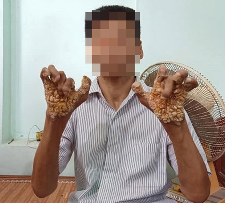 Nhiễm virus HPV có thể bị mắc bệnh hiếm gặp "người cây" EV? - Ảnh 1.