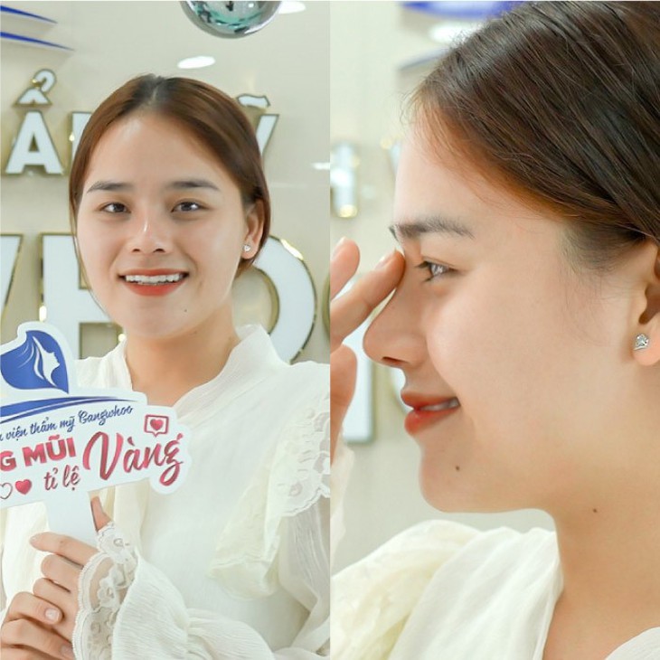 Hậu nâng mũi - Quán quân Thách thức danh hài "Thánh sún" lột xác ngoạn mục - Ảnh 2.