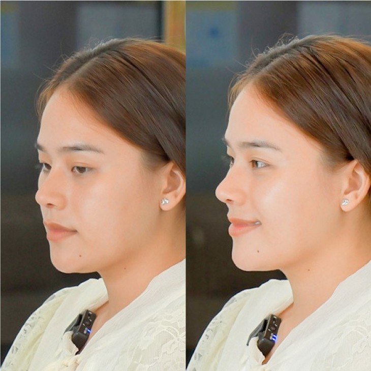 Hậu nâng mũi - Quán quân Thách thức danh hài "Thánh sún" lột xác ngoạn mục - Ảnh 3.