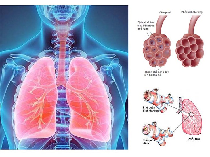 Viêm phế quản mạn tính ở người lớn - Ảnh 2.