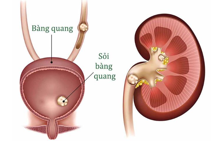 Nhận biết triệu chứng của sỏi bàng quang và cách điều trị
