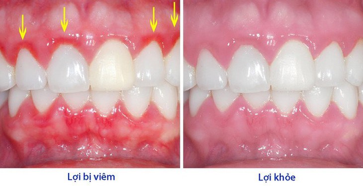 Điều trị viêm lợi bằng thuốc gì? - Ảnh 1.