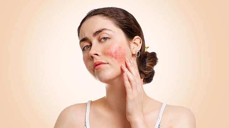 Phương pháp mới điều trị bệnh Lupus ban đỏ  - Ảnh 1.