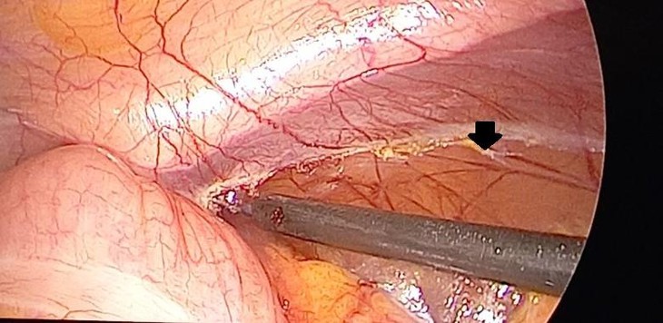 'Bóc' thành công khối u mạc treo ruột khổng lồ hiếm gặp - Ảnh 1. 'Bóc' thành công khối u mạc treo ruột khổng lồ hiếm gặp - Ảnh 1.