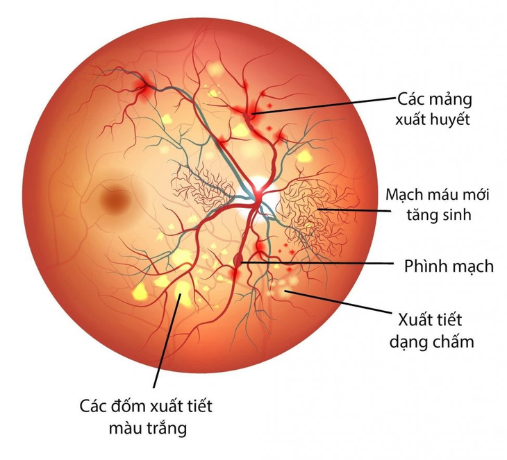 Điều trị biến chứng võng mạc do đái tháo đường - Ảnh 1.