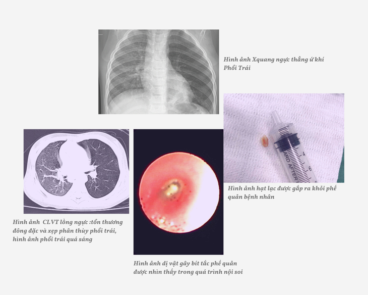 Nghệ An: Cứu sống trẻ mắc dị vật đường thở - Ảnh 1.