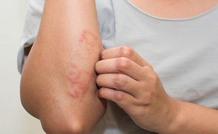 Biểu hiện viêm da cơ địa ở từng lứa tuổi - Ảnh 3.