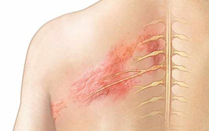 Đau sau zona thần kinh và thời gian hồi phục bệnh zona là bao lâu?