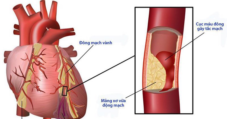 Điều trị ngăn ngừa biến chứng tim mạch ở bệnh nhân đái tháo đường - Ảnh 1. Điều trị ngăn ngừa biến chứng tim mạch ở bệnh nhân đái tháo đường - Ảnh 1.