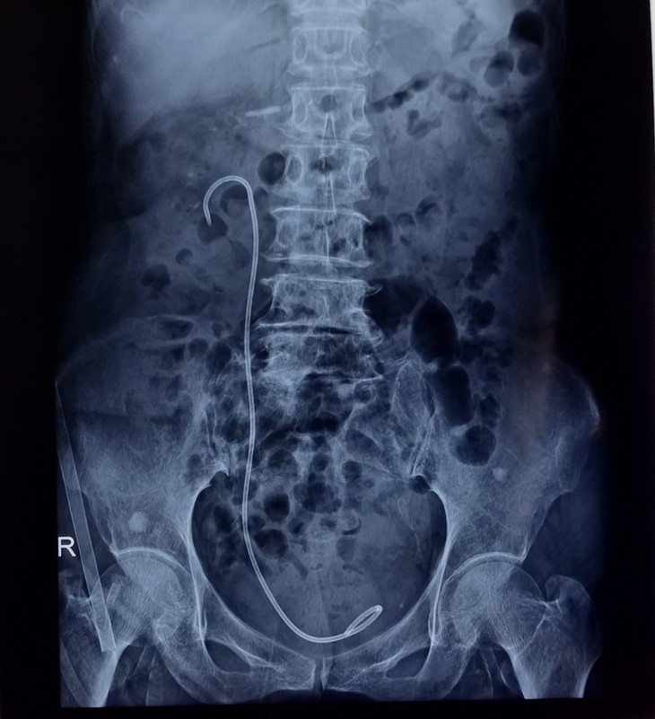 Phẫu thuật nội soi 1 lỗ (mini PCNL) ở tư thế nằm ngửa cho bệnh nhân bị sót sỏi, thận mủ và áp xe quanh thận - Ảnh 2.