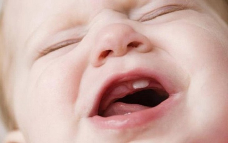 Bệnh viêm lợi ở trẻ em do nguyên nhân nào? - Ảnh 2.