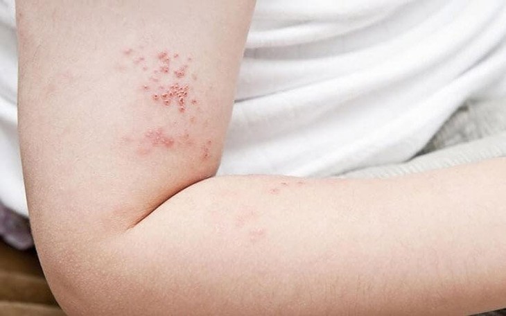 Coi chừng những biến chứng nguy hiểm của zona thần kinh