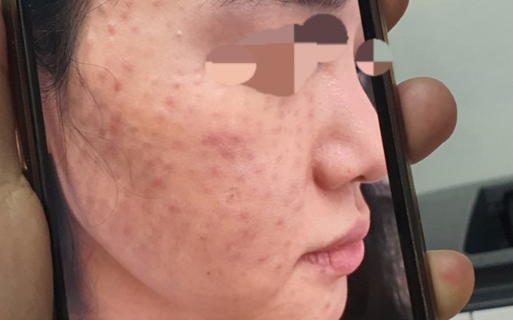 Tiêm meso trẻ hóa da, nhiều người nhập viện 'chữa cháy'